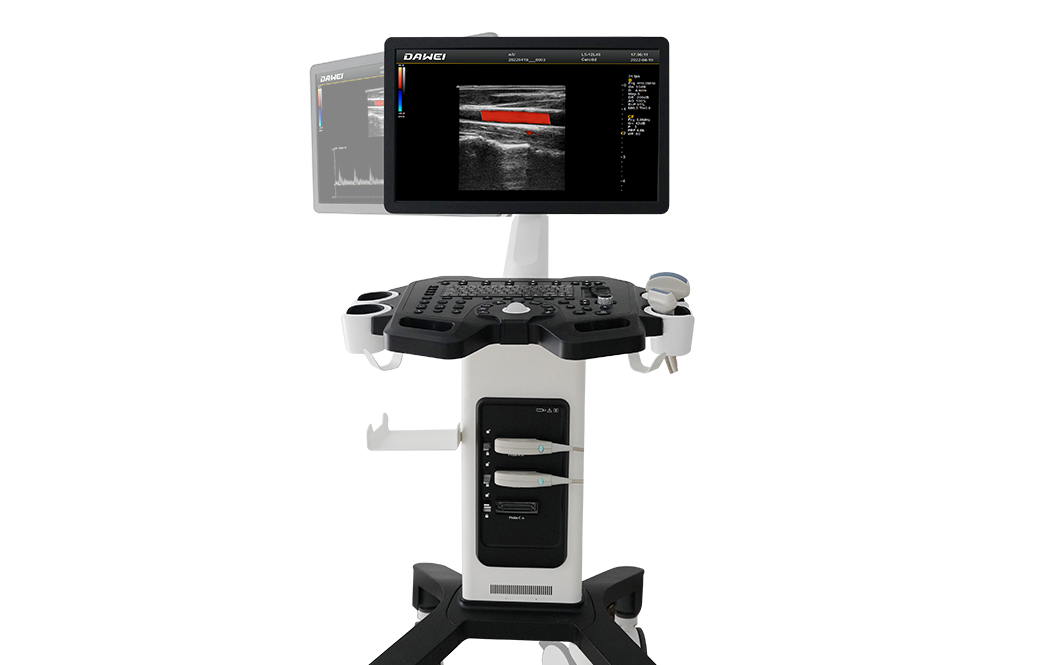 IMT血管内中膜自动测量